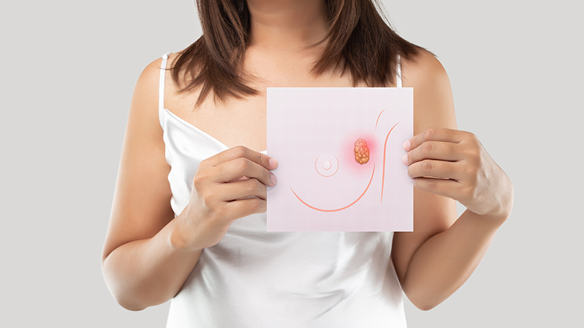 乳癌手術一定要清除淋巴結嗎？最新手術趨勢圖解說明