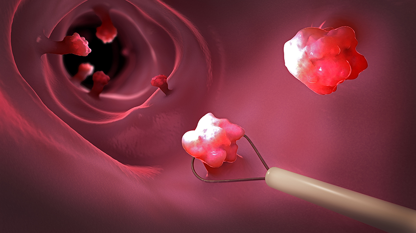 腸瘜肉不等於大腸癌 做完大腸鏡，一定要先問醫生這個問題